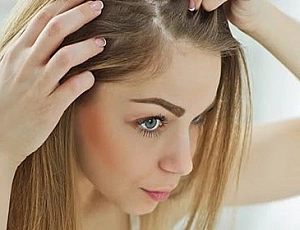 20 Best Anti-Dandruff Remedies