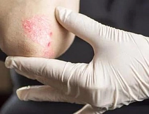 20 best remedies for psoriasis