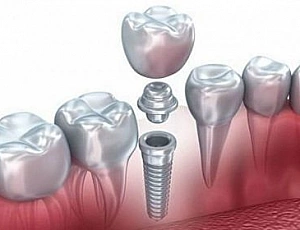 10 meilleures cliniques d'implants dentaires à Moscou