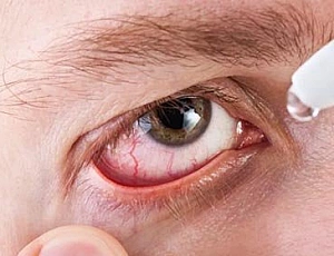 15 best drops for conjunctivitis