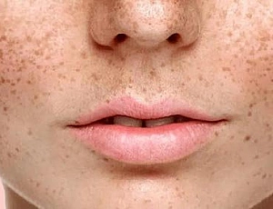 15 meilleurs remèdes contre les taches de vieillesse sur le visage