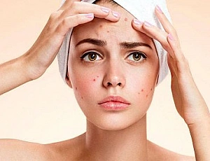 10 best vitamins for acne