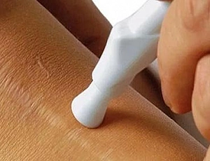 15 best remedies for scars and scars