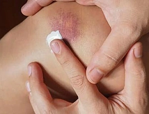 10 best remedies for bruises and bruises