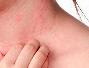 Top 10 Urticaria Remedies