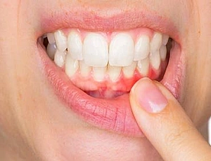 10 melhores cremes dentais para periodontite e doença periodontal