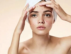 10 Best Acne Treatments with iHerb