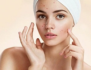 10 pomadas mais eficazes para acne